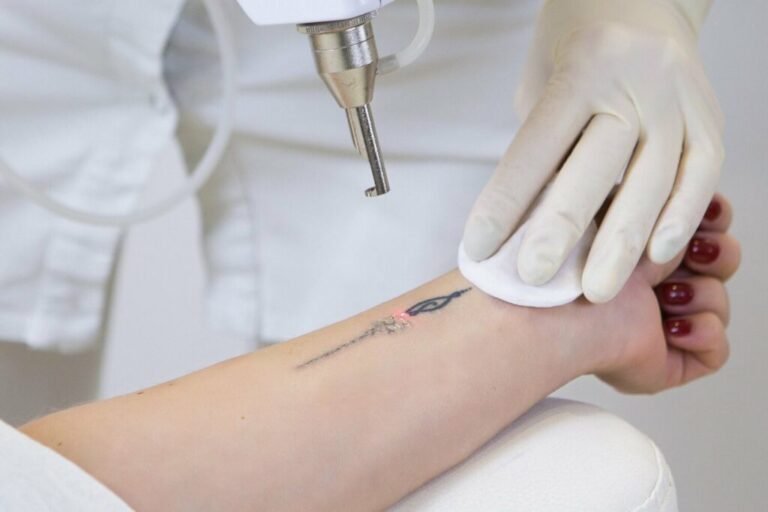 Can Permanent Tattoo Be Removed by Laser?