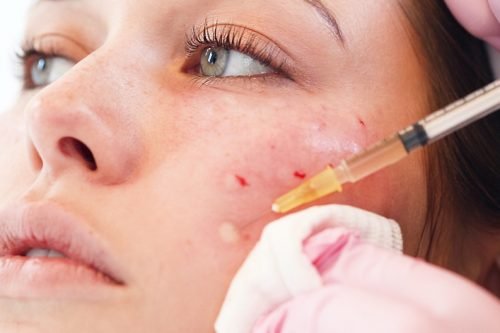 Vampire Facial Treatment